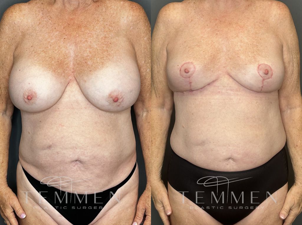 Implant Removal And Lift Before & After