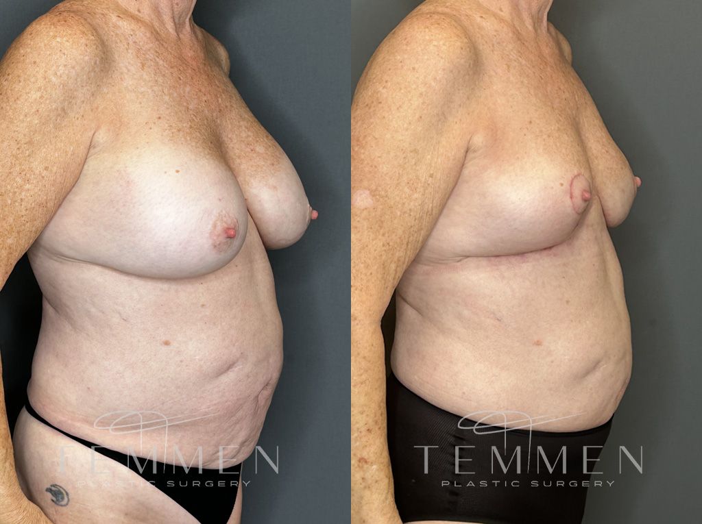 Implant Removal And Lift Before & After