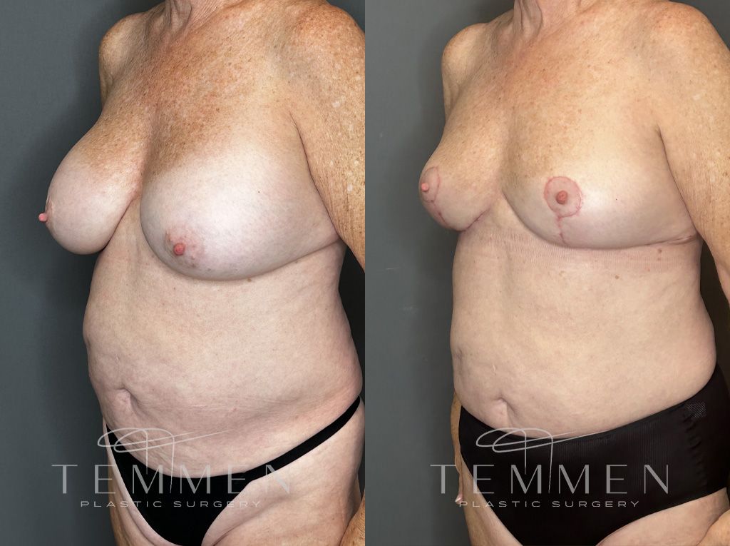 Implant Removal And Lift Before & After