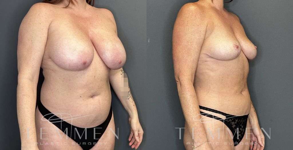 Implant Removal And Lift Before & After