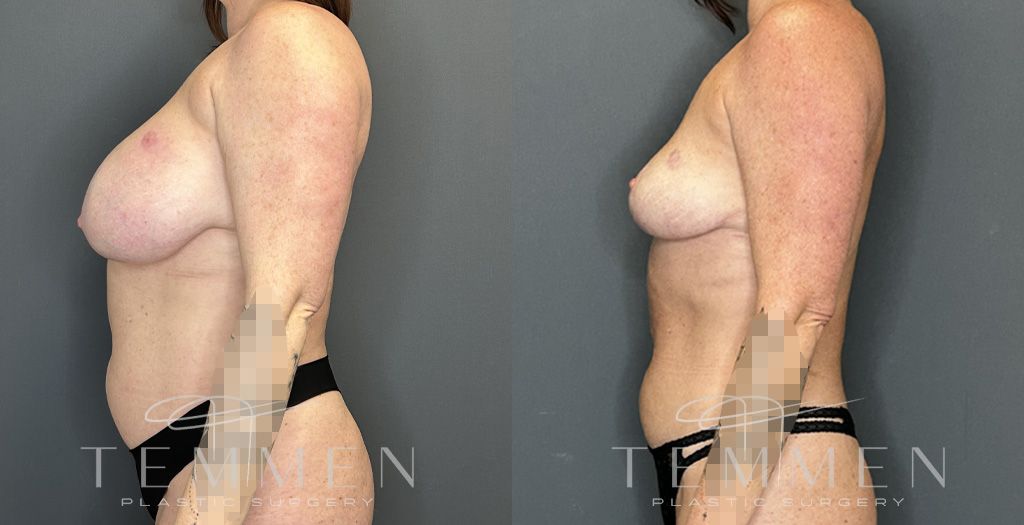 Implant Removal And Lift Before & After