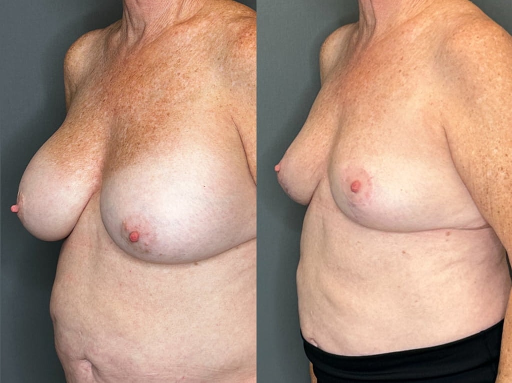 Implant Removal And Lift Before & After