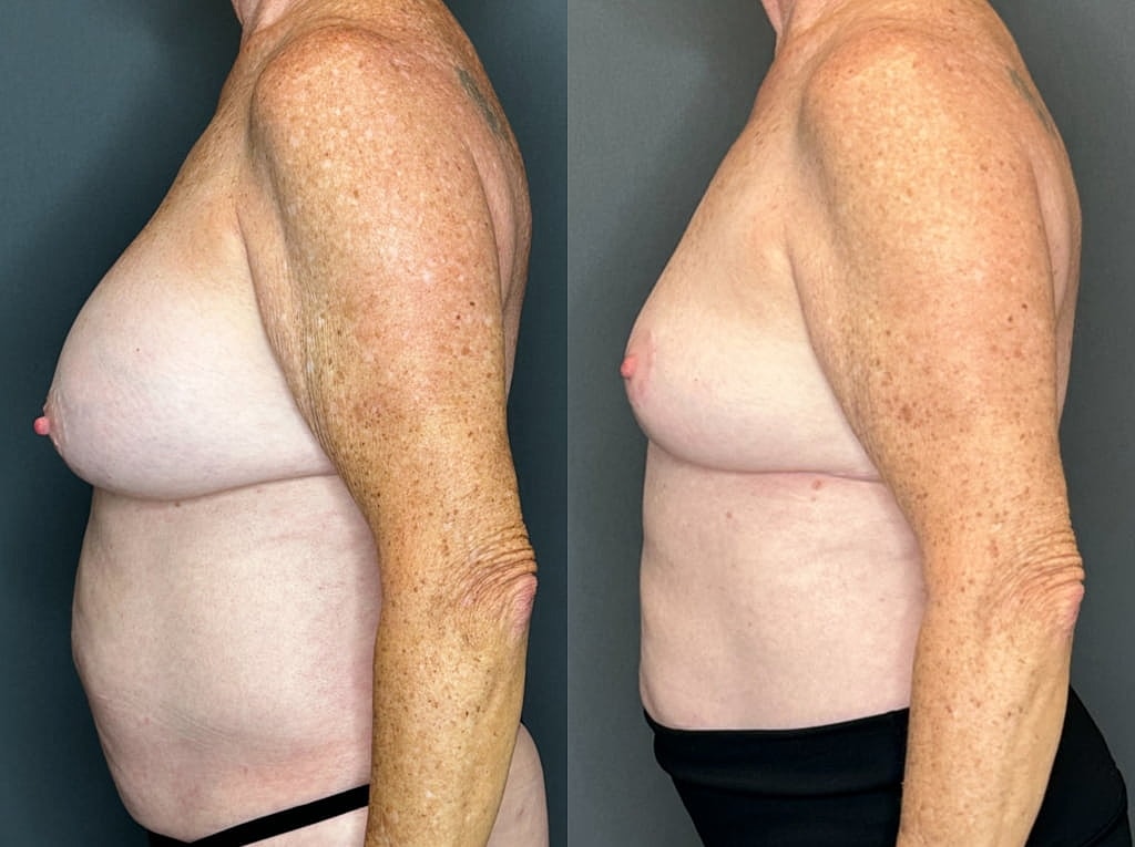 Implant Removal And Lift Before & After