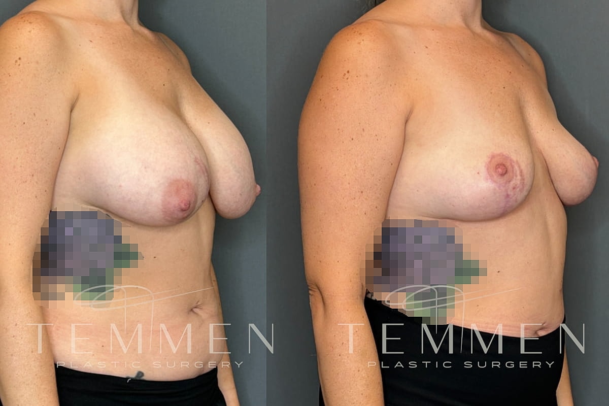 Implant Removal And Lift Before & After