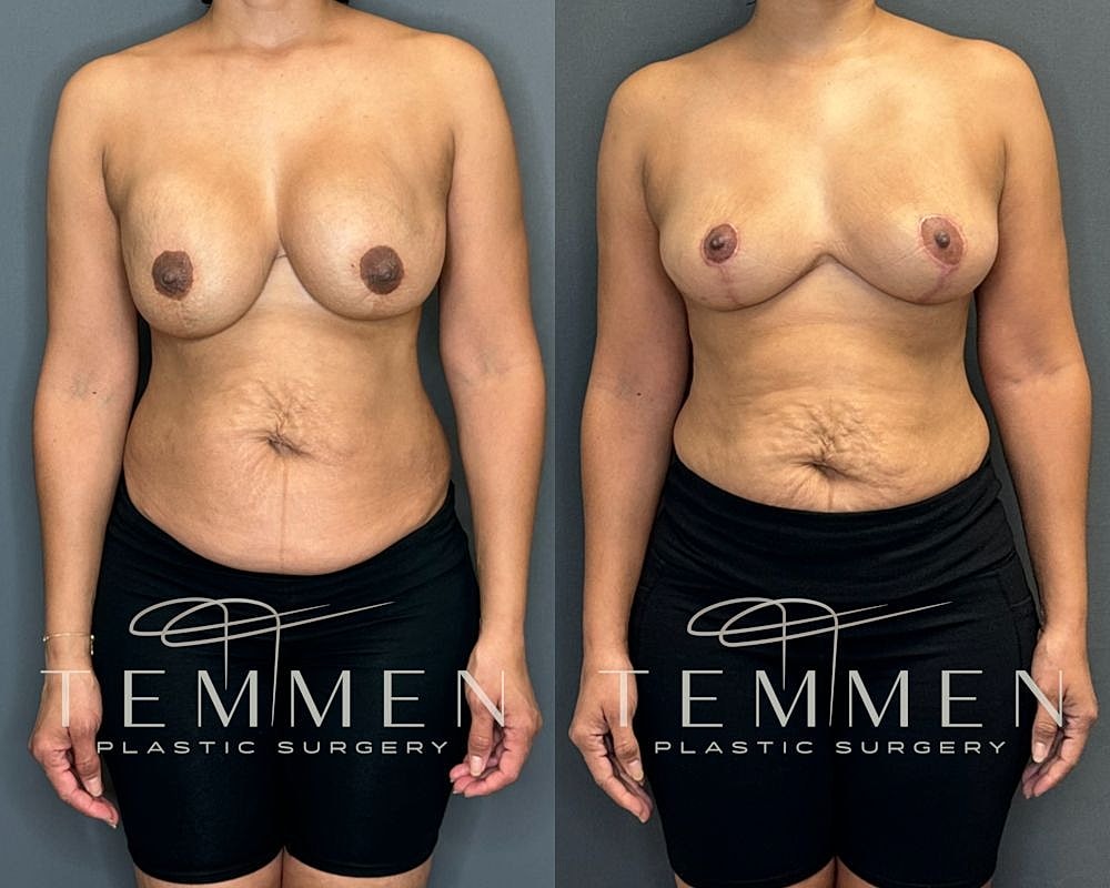 Before and after plastic surgery transformation.