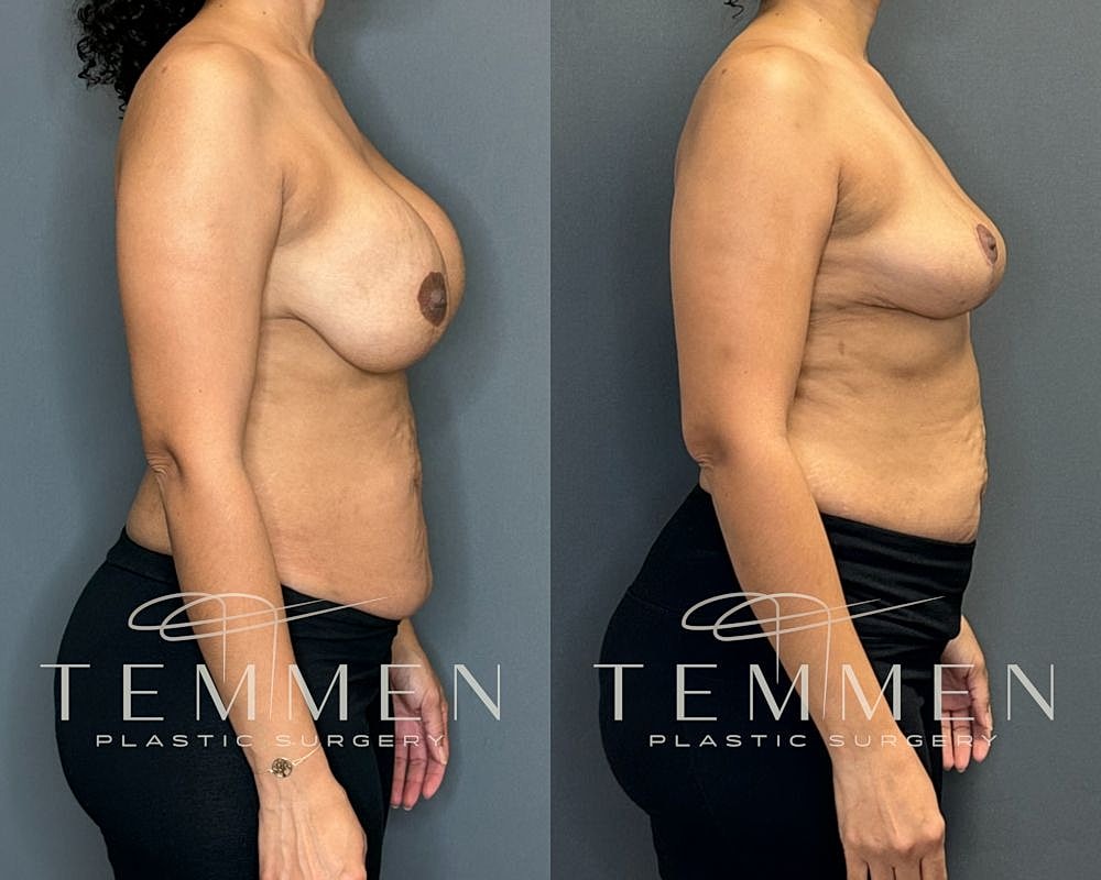 Before and after plastic surgery side profile.