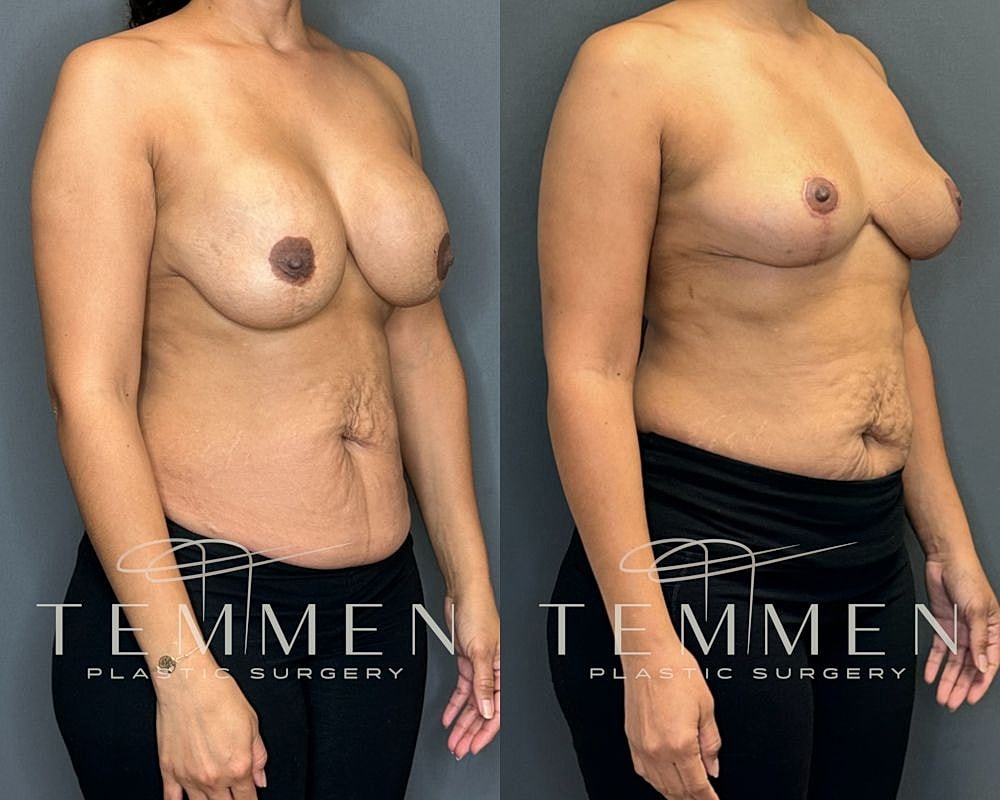 Before and after breast surgery results comparison.