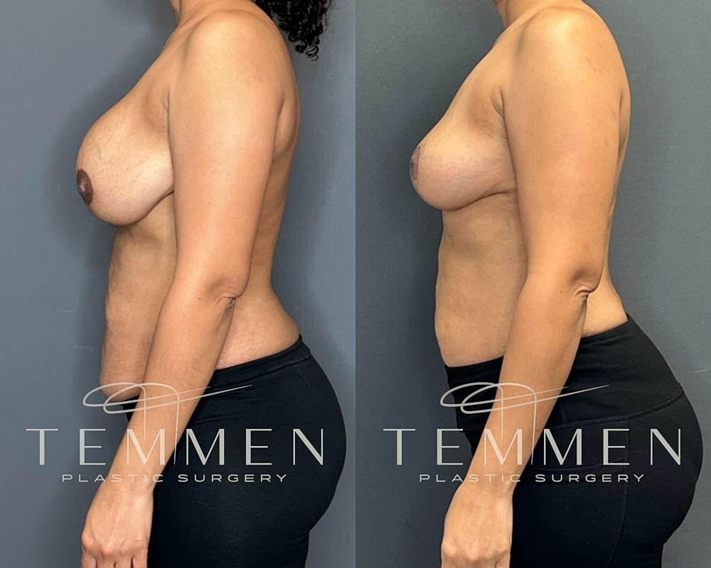 Before and after breast surgery comparison image