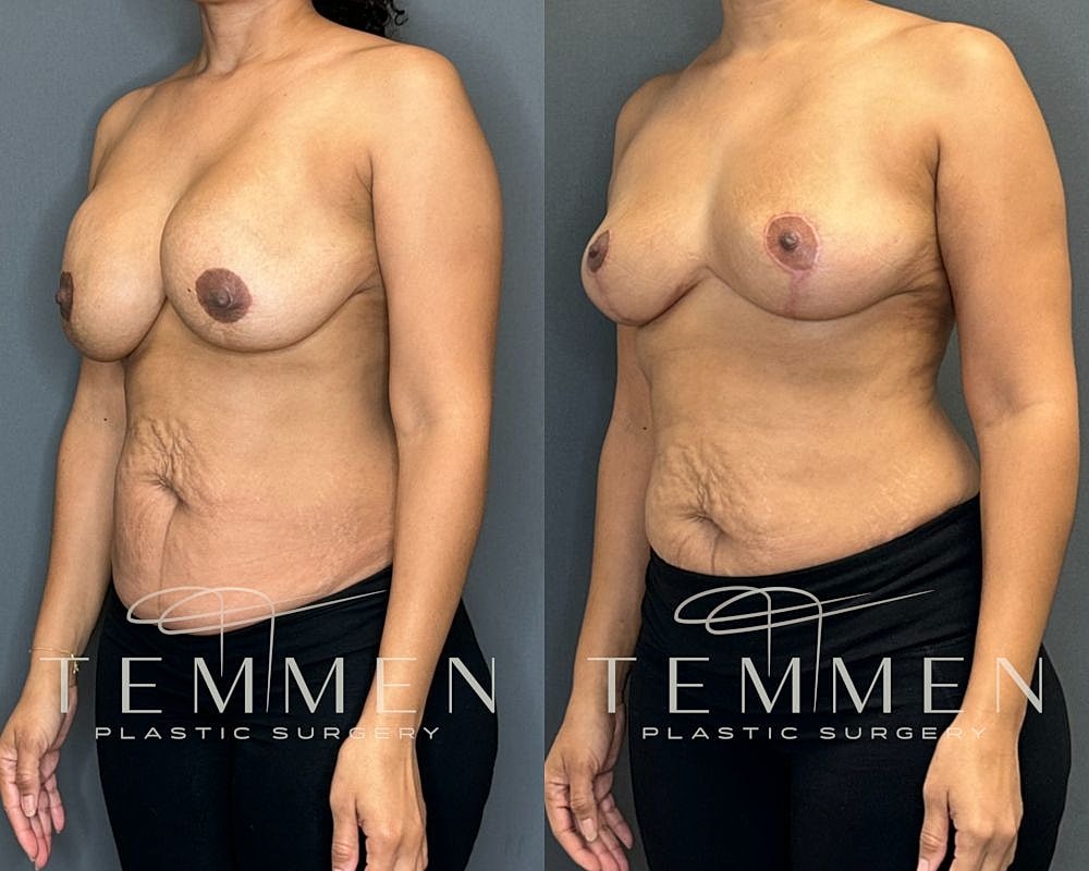 Before and after plastic surgery transformation.