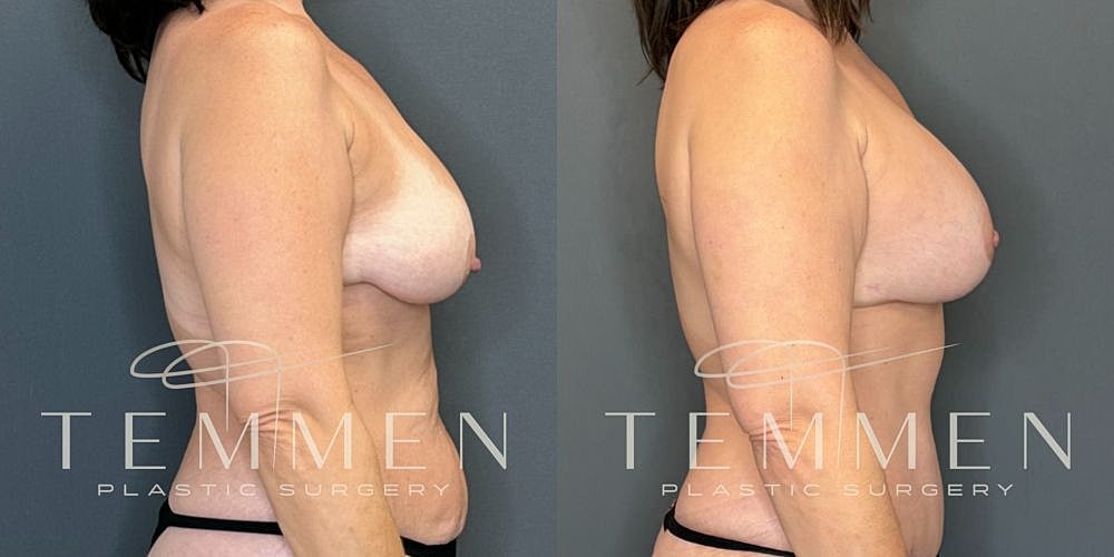 Before and after plastic surgery side profile.