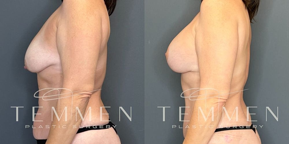 Plastic surgery before and after comparison image.