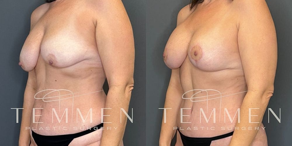 Before and after plastic surgery comparison image