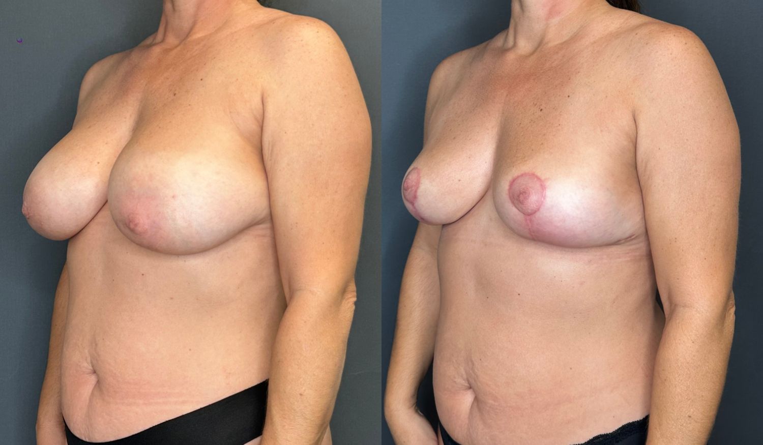 Implant Removal And Lift Before & After