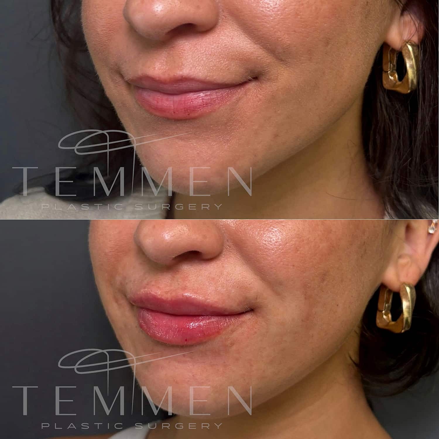 Lip Filler Before & After