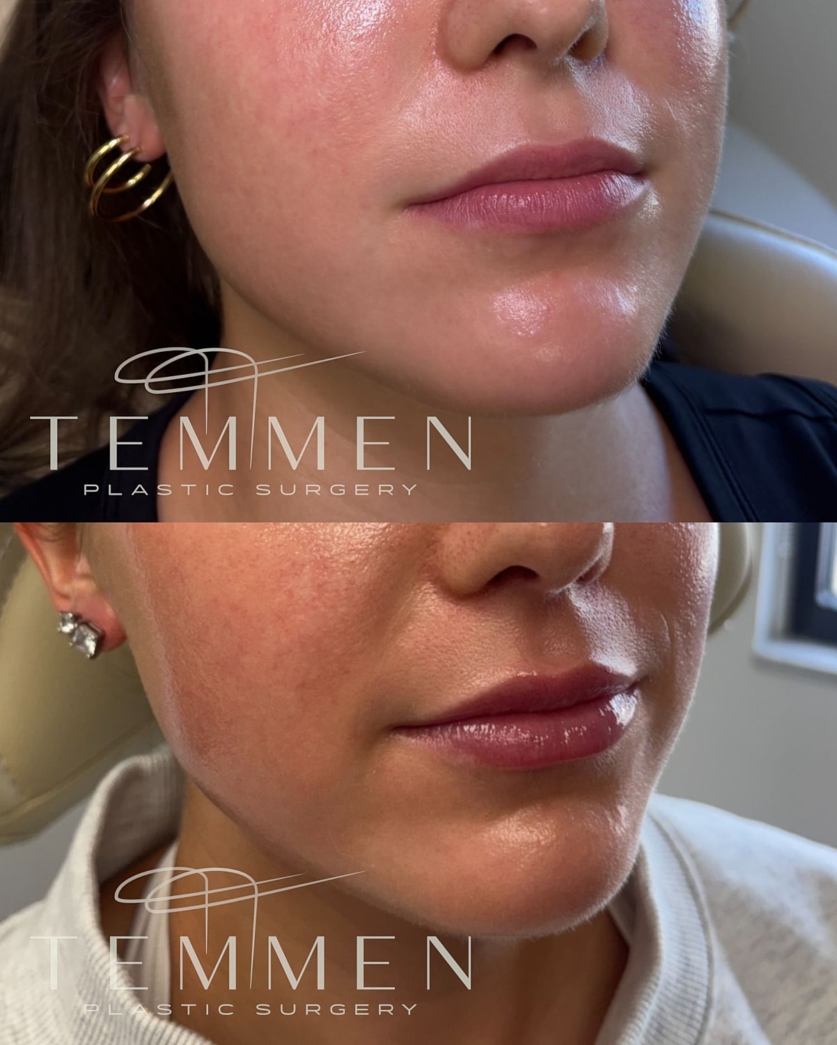 Lip Filler Before & After