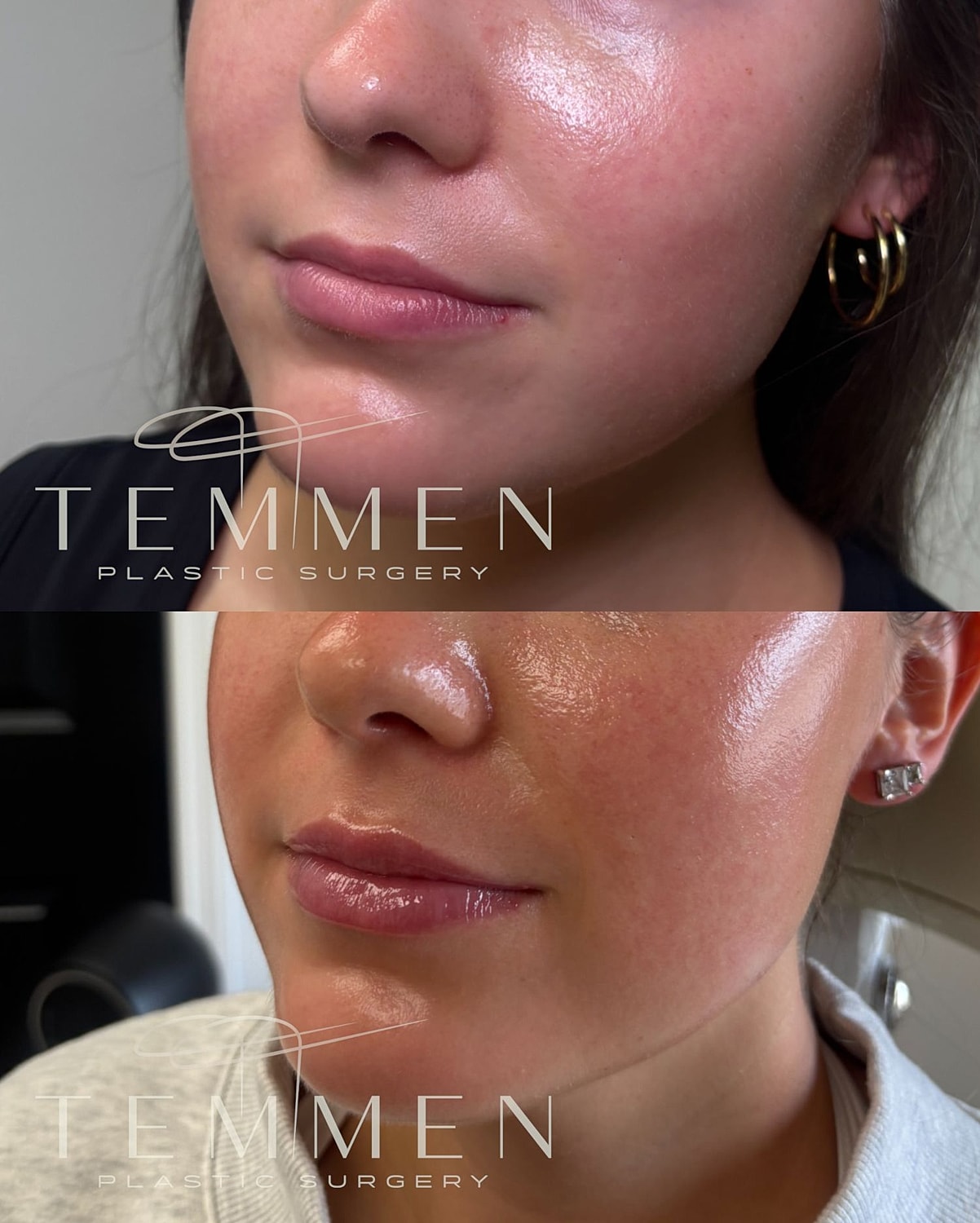 Lip Filler Before & After