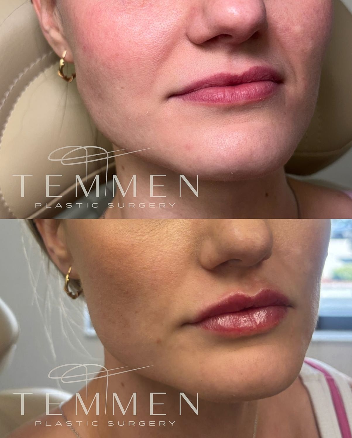 Lip Filler Before & After