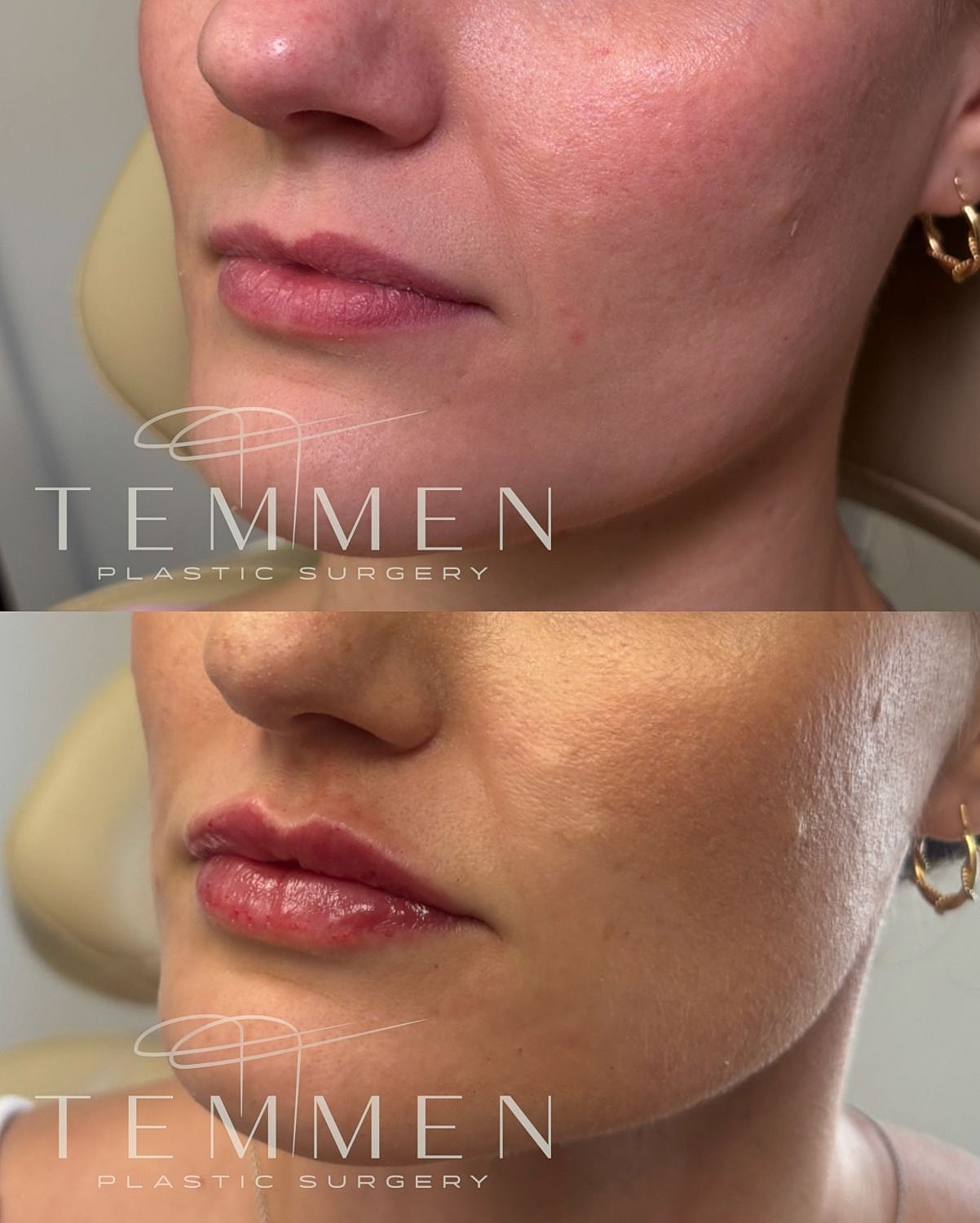 Lip Filler Before & After