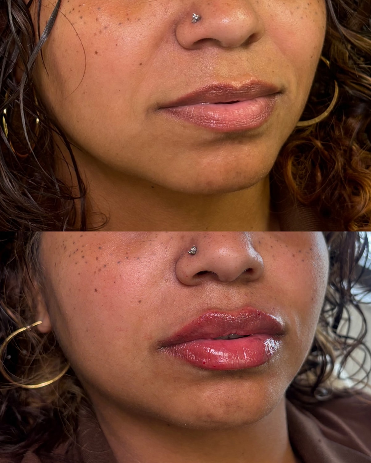 Lip Filler Before & After