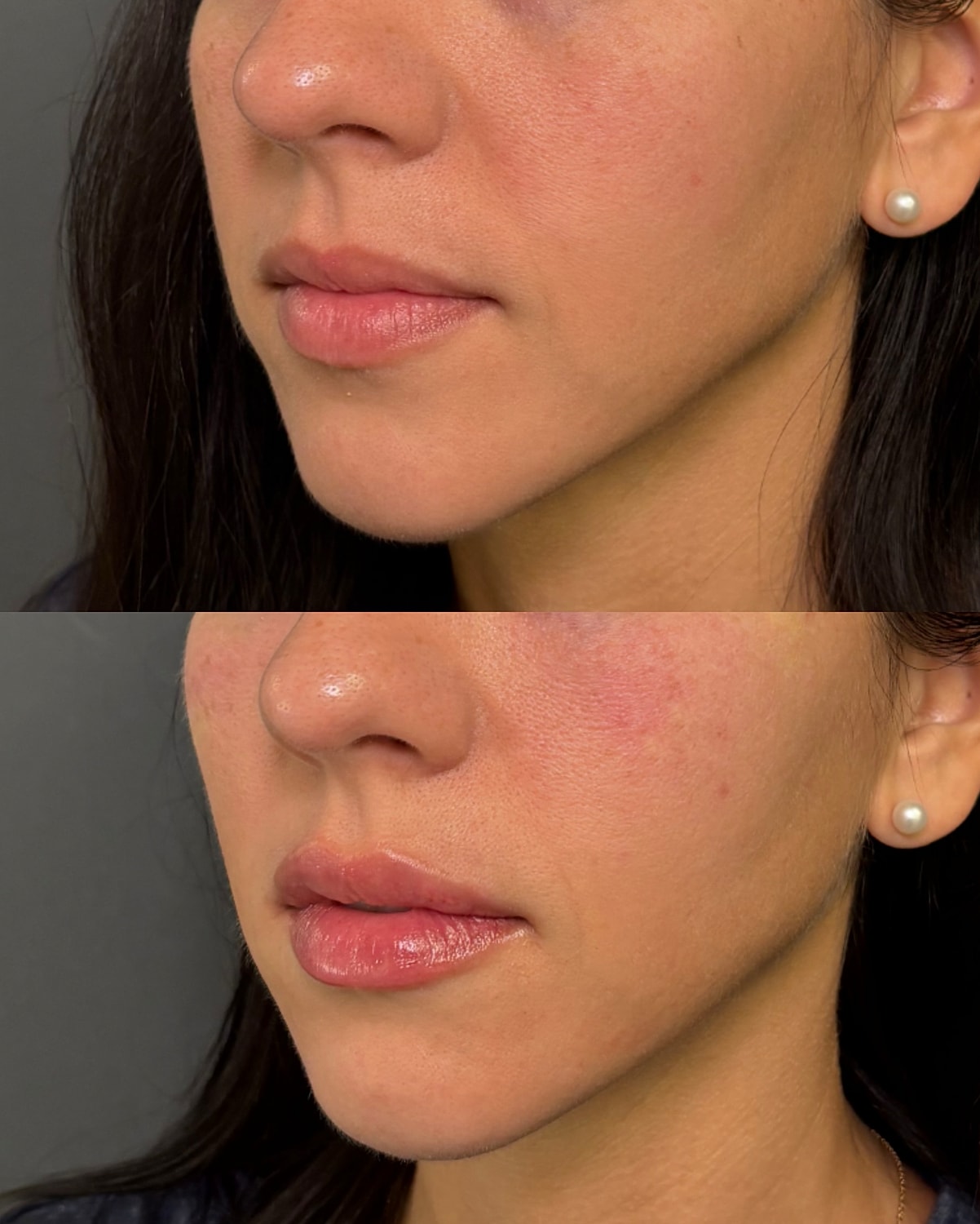 Lip Filler Before & After