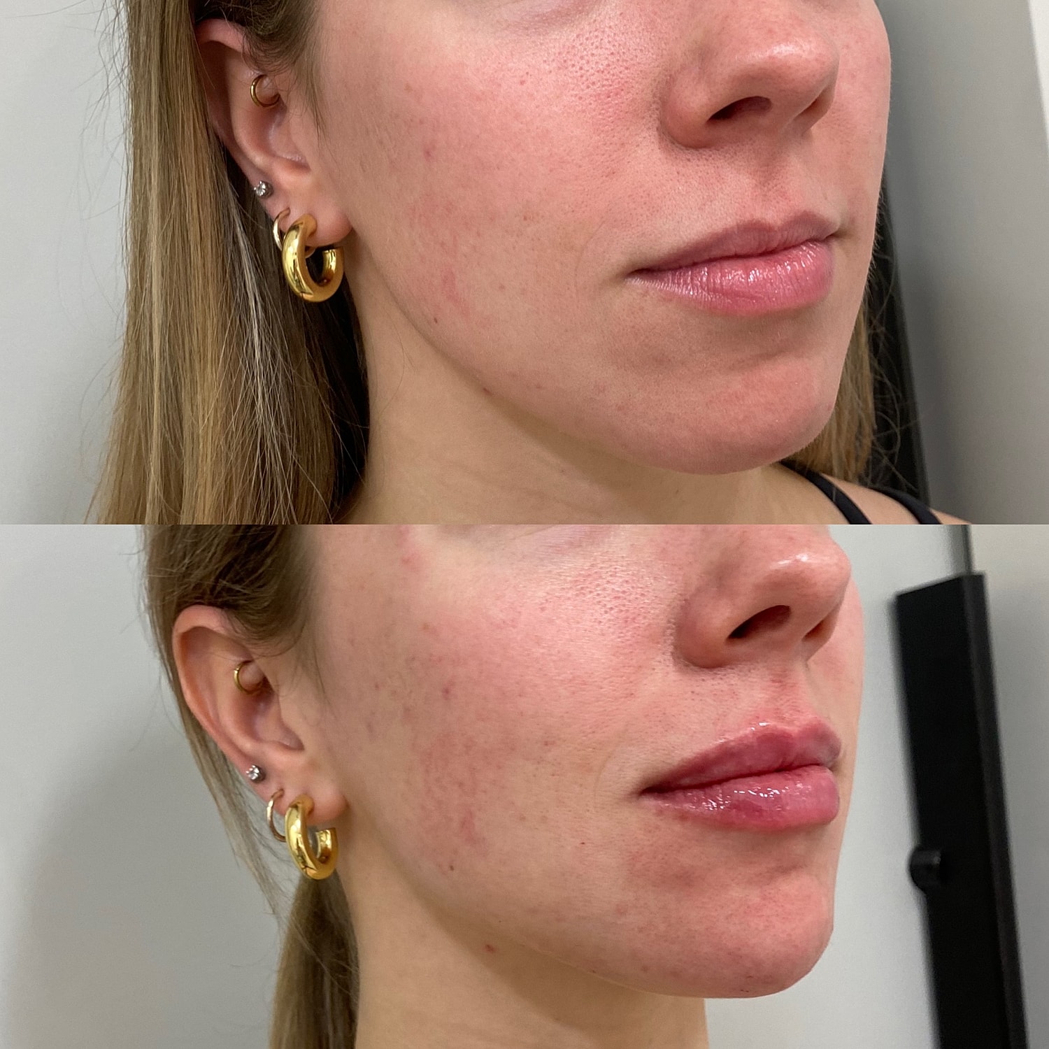 Lip Filler Before & After