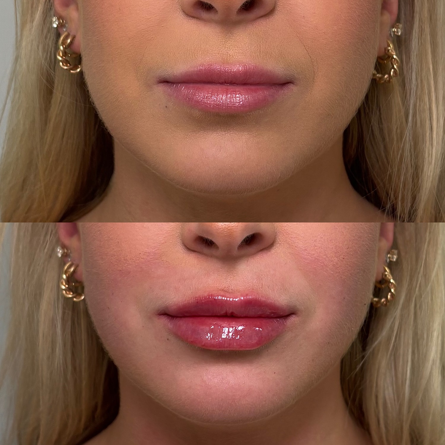 Lip Filler Before & After