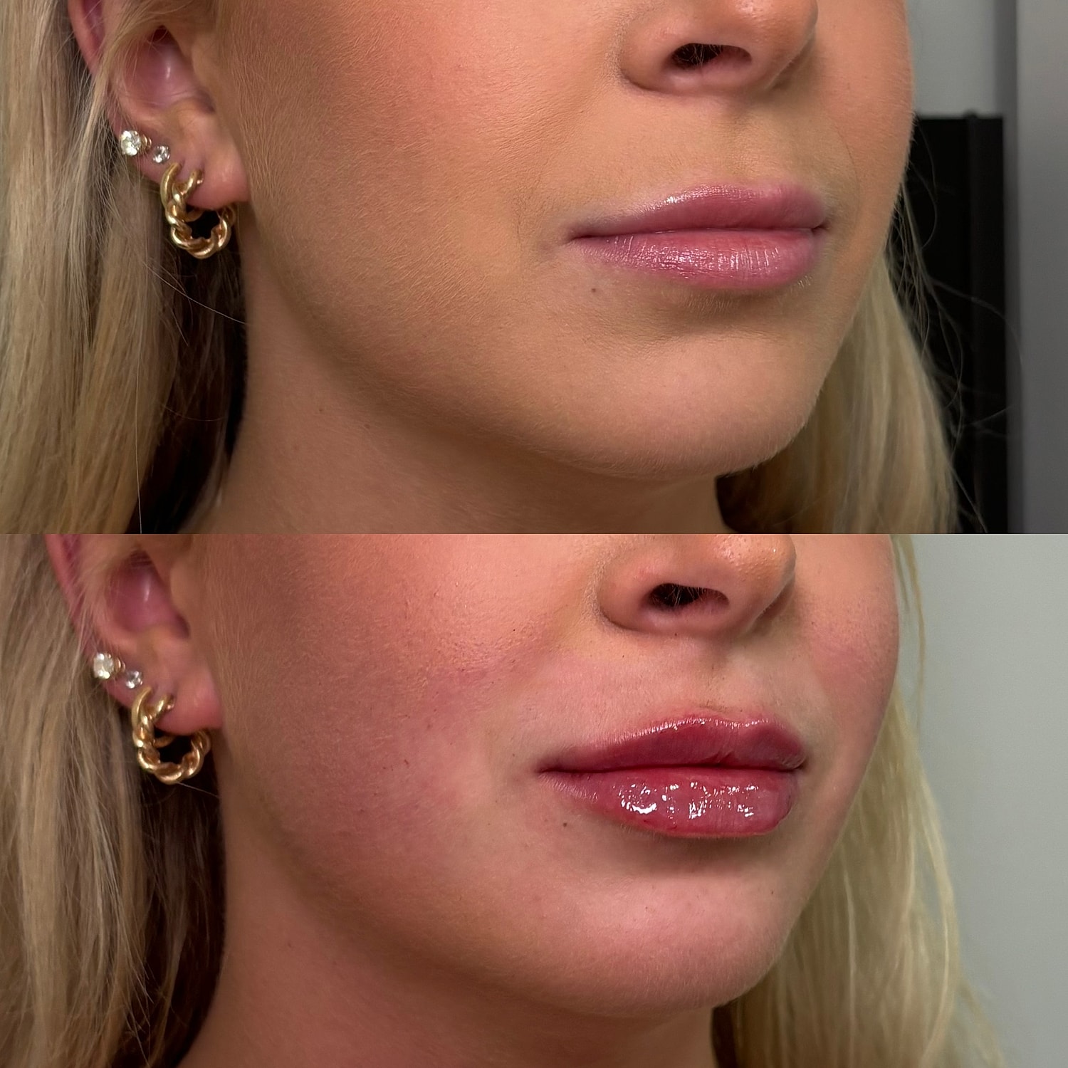 Lip Filler Before & After