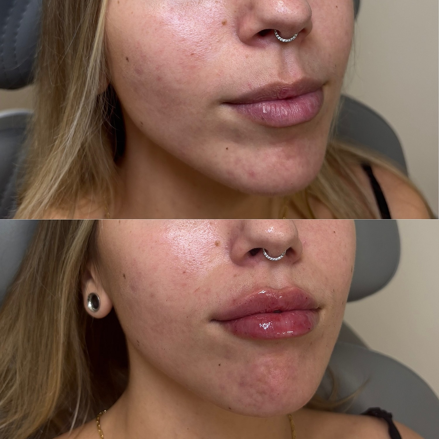 Lip Filler Before & After