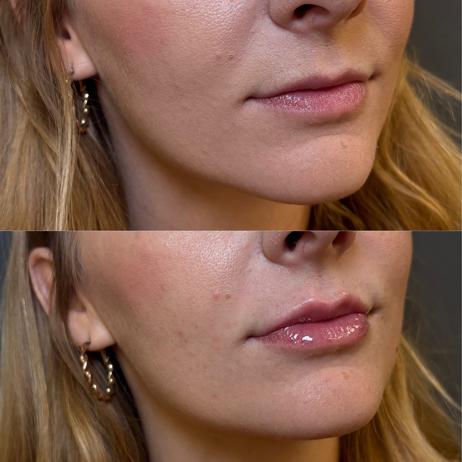 Lip Filler Before & After