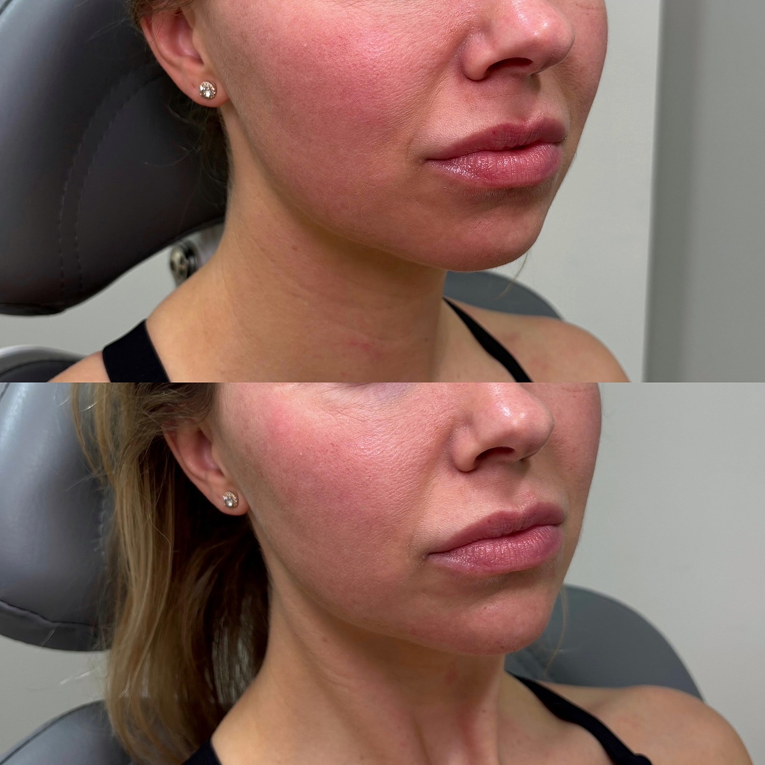 Lip Filler Before & After