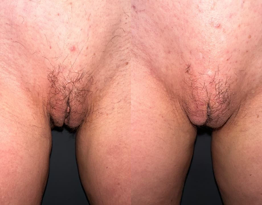 Labia Majora Reduction Before & After