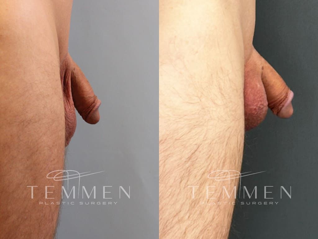 Scrotal Reduction Before & After