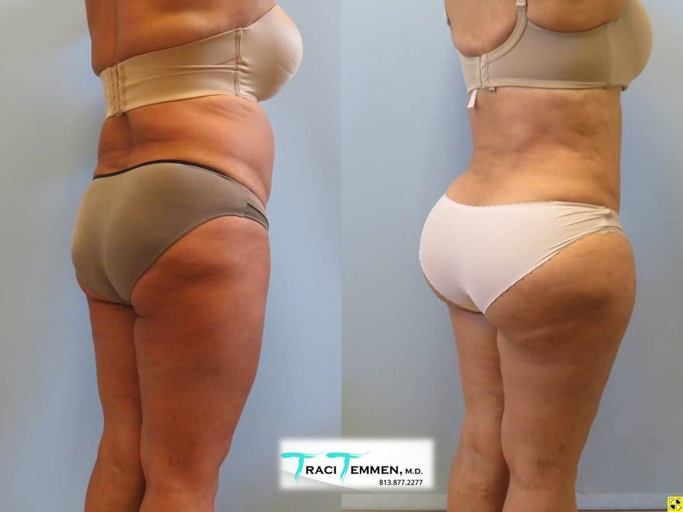 Brazilian Mommy Makeover Before & After