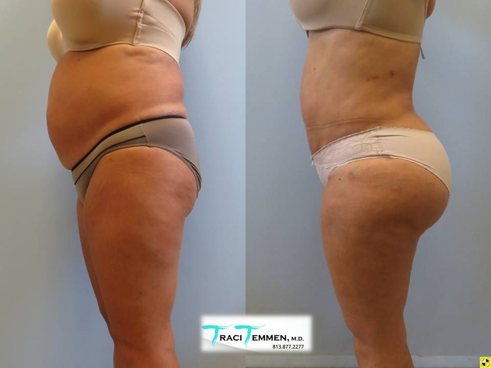 Brazilian Mommy Makeover Before & After