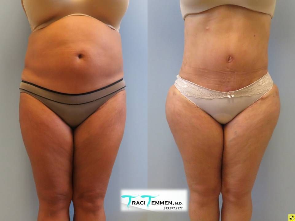 Brazilian Mommy Makeover Before & After