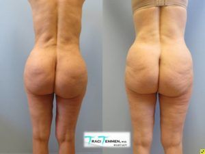 Brazilian Mommy Makeover Before & After