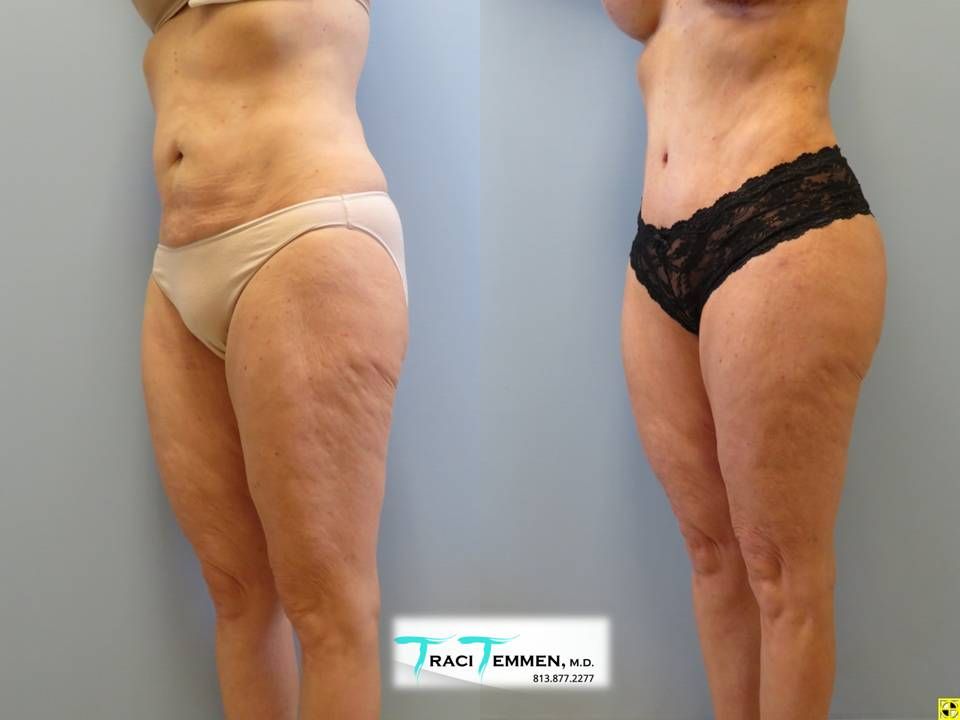 Brazilian Mommy Makeover Before & After