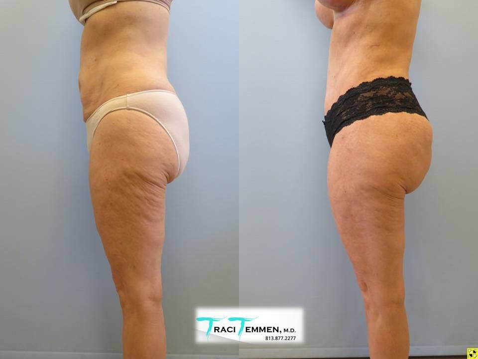 Brazilian Mommy Makeover Before & After