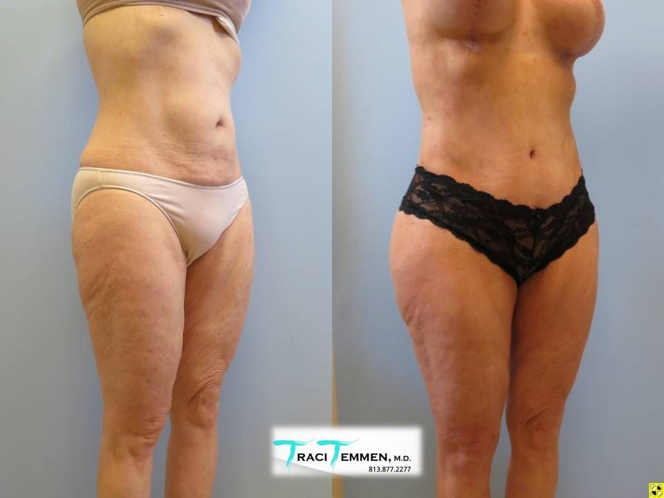 Brazilian Mommy Makeover Before & After