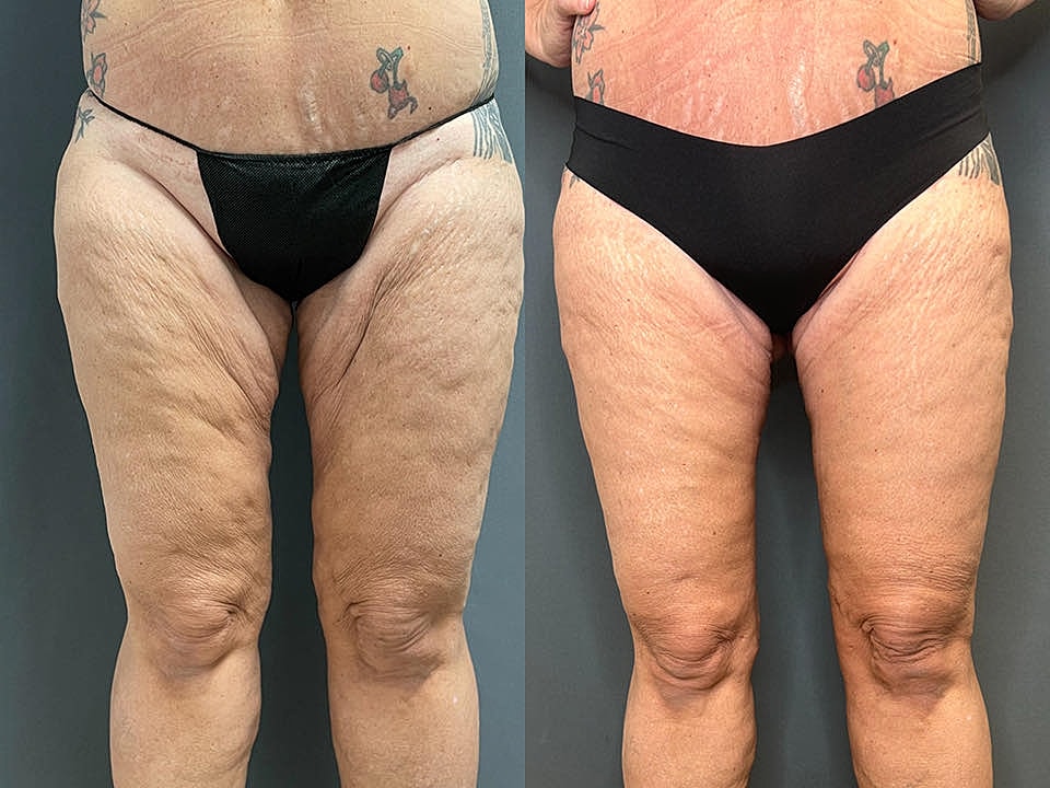 Thigh Lift Before & After