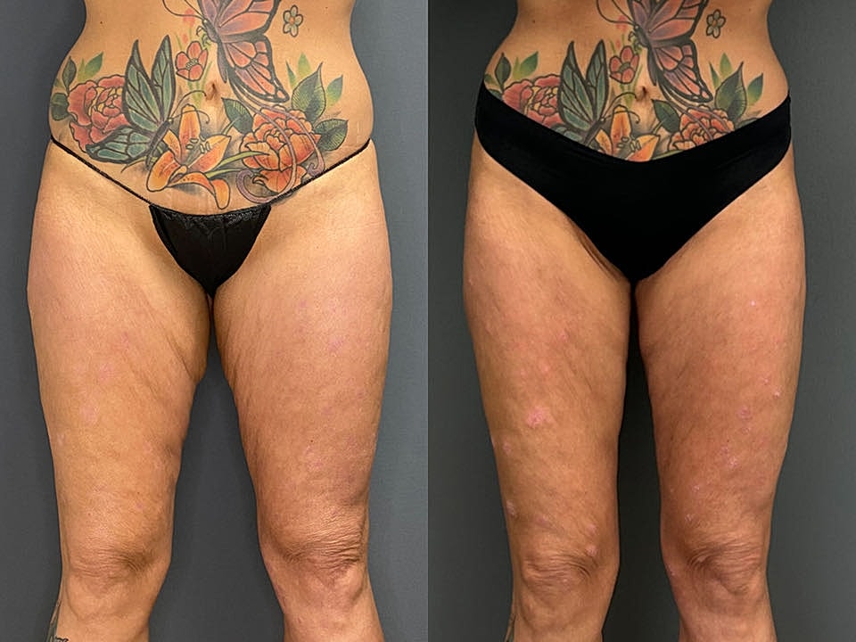 Thigh Lift Before & After