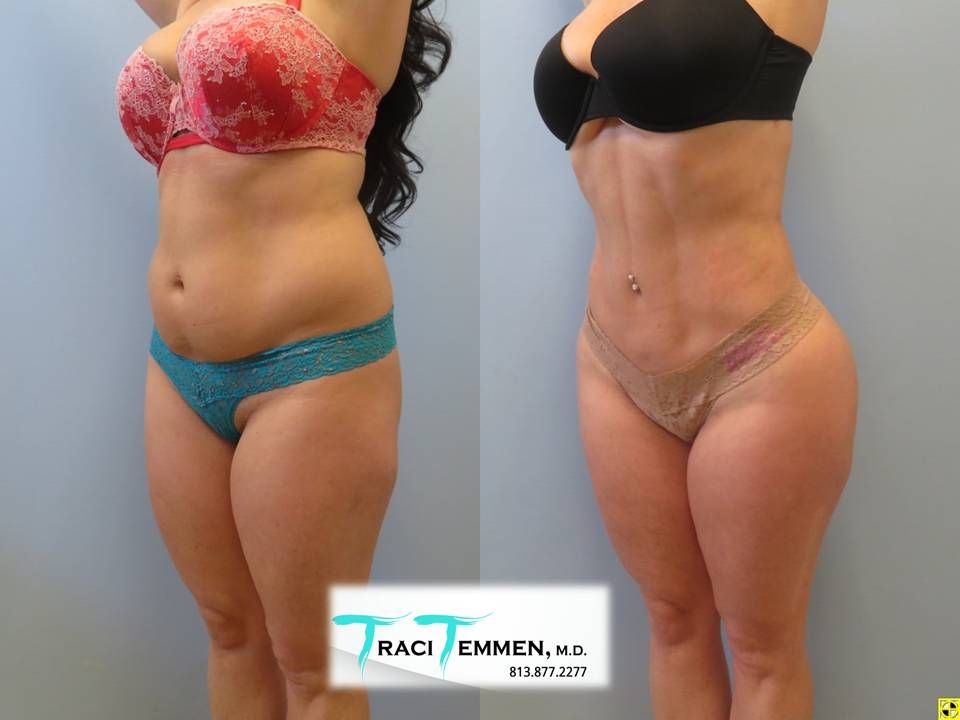 Lipoetching Before & After