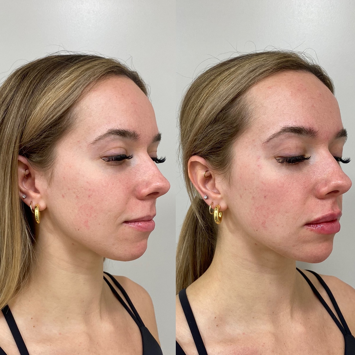 Chin Filler Before & After