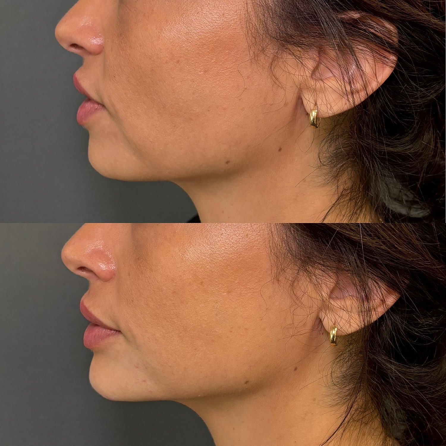 Chin Filler Before & After