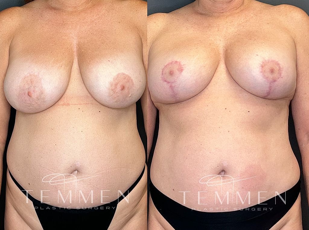 Post-operative breast procedure before and after images.