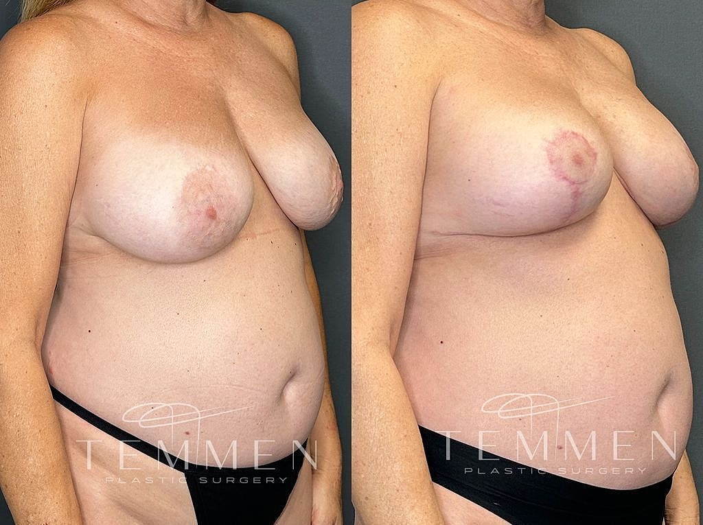 Before and after breast enhancement surgery comparison.