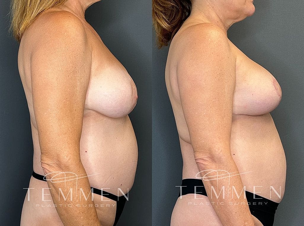 Before and after plastic surgery side view comparison.
