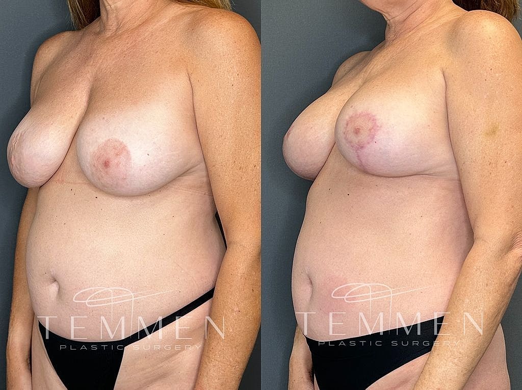 Before and after breast surgery results.