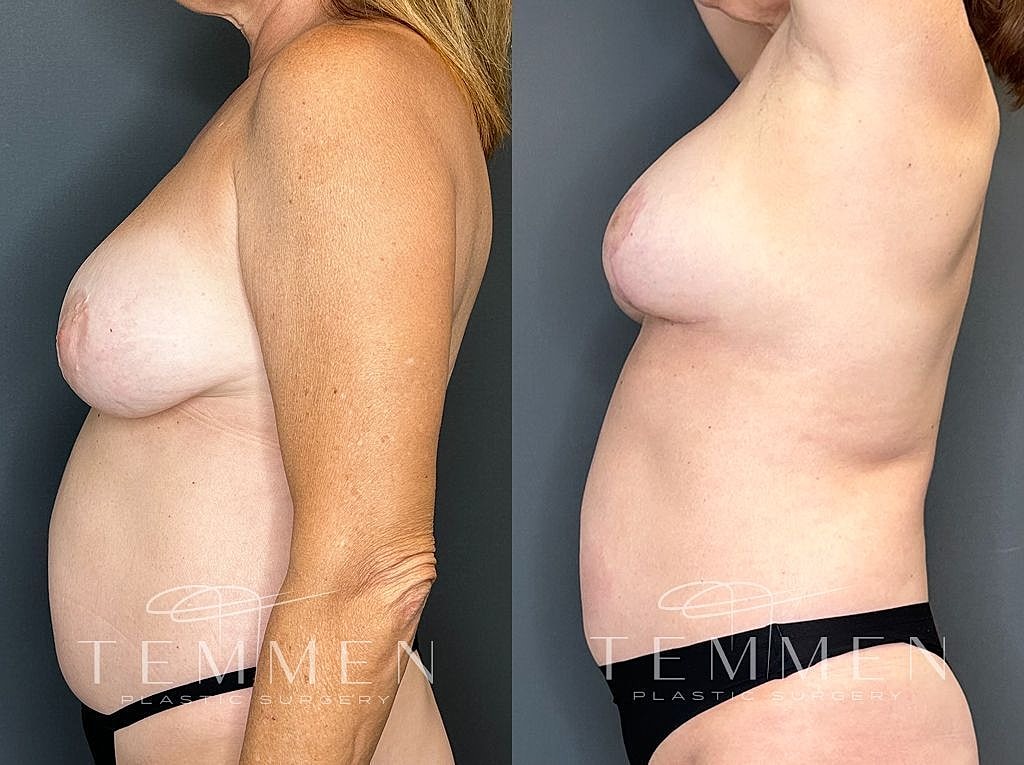 Side profile of woman before and after surgery.