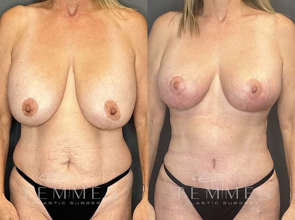 Before and after breast surgery transformation.